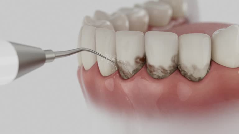 Reliable Dental Implants contractor in Cherokee, IA by Smile Center Dentistry